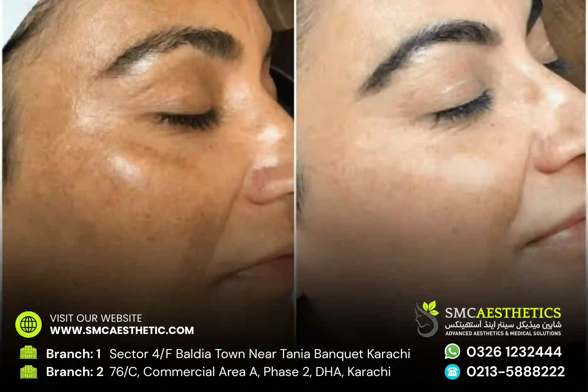 Pigmentation Treatment in Karachi - Melasma Care at SMC Aesthetics